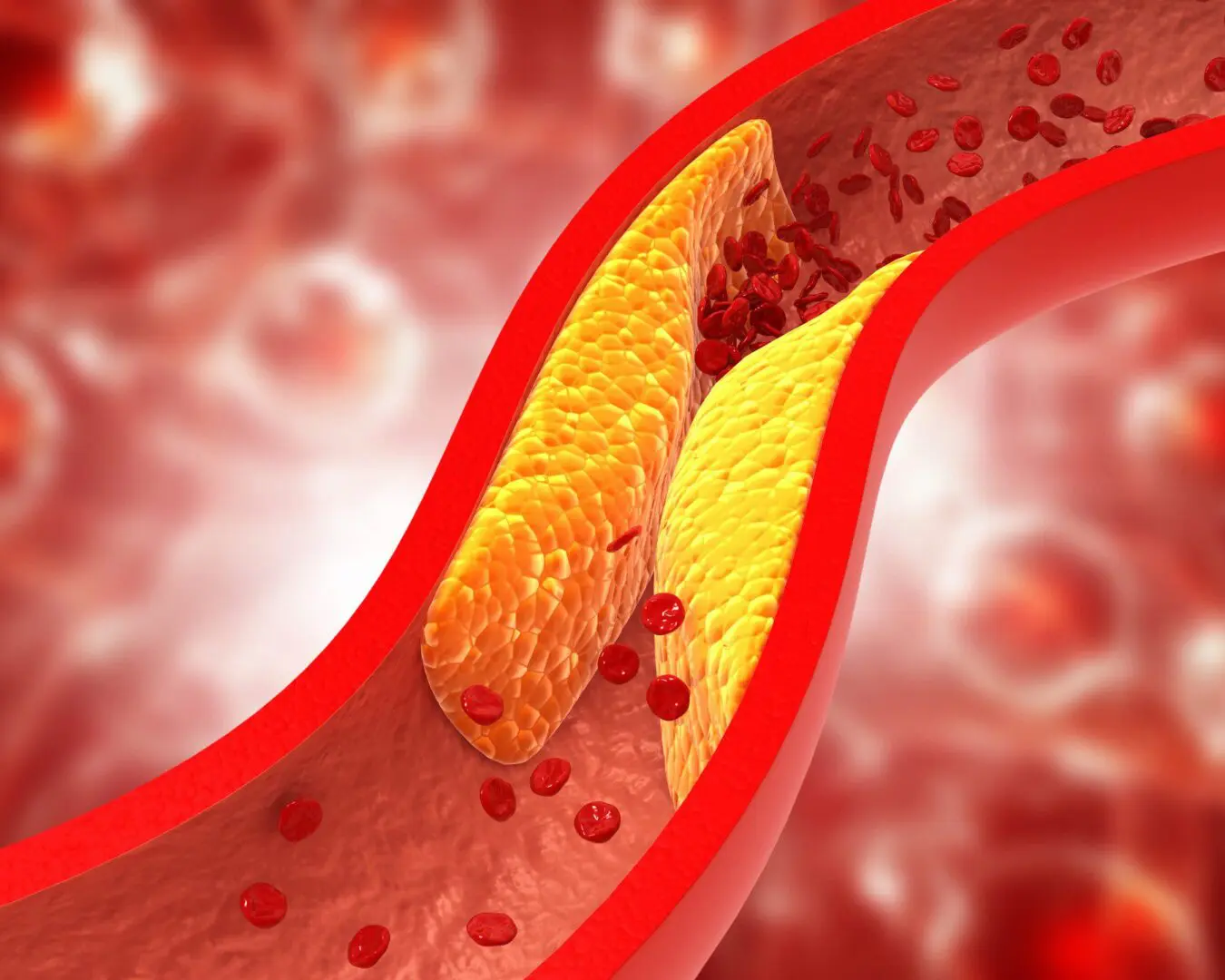 Blood flow blocked by arterial plaque.
